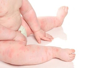 cuerpo de bebé con alergia Tipos de alergias en bebés