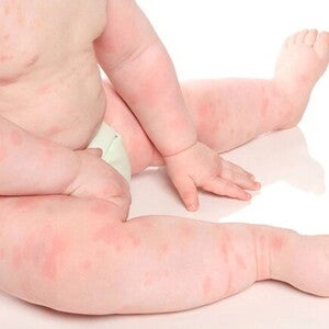 cuerpo de bebé con alergia Tipos de alergias en bebés