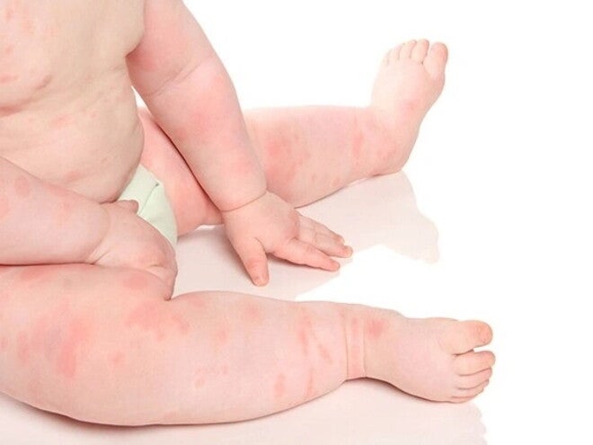 cuerpo de bebé con alergia Tipos de alergias en bebés